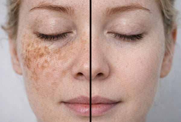 Comparação antes e depois do tratamento de melasma em mulher de pele muito clara, mostrando redução significativa das manchas escuras no rosto e melhora da uniformidade da pele.